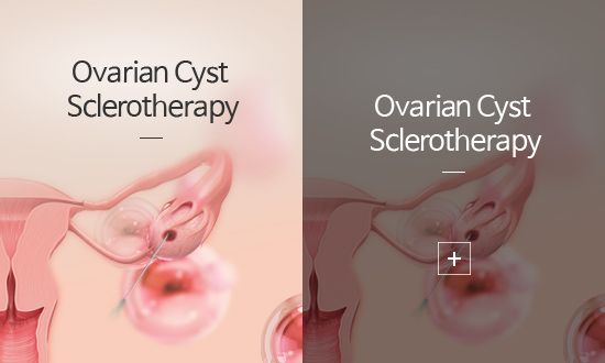 난소낭종경화술