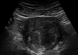 실시간 초음파 영상