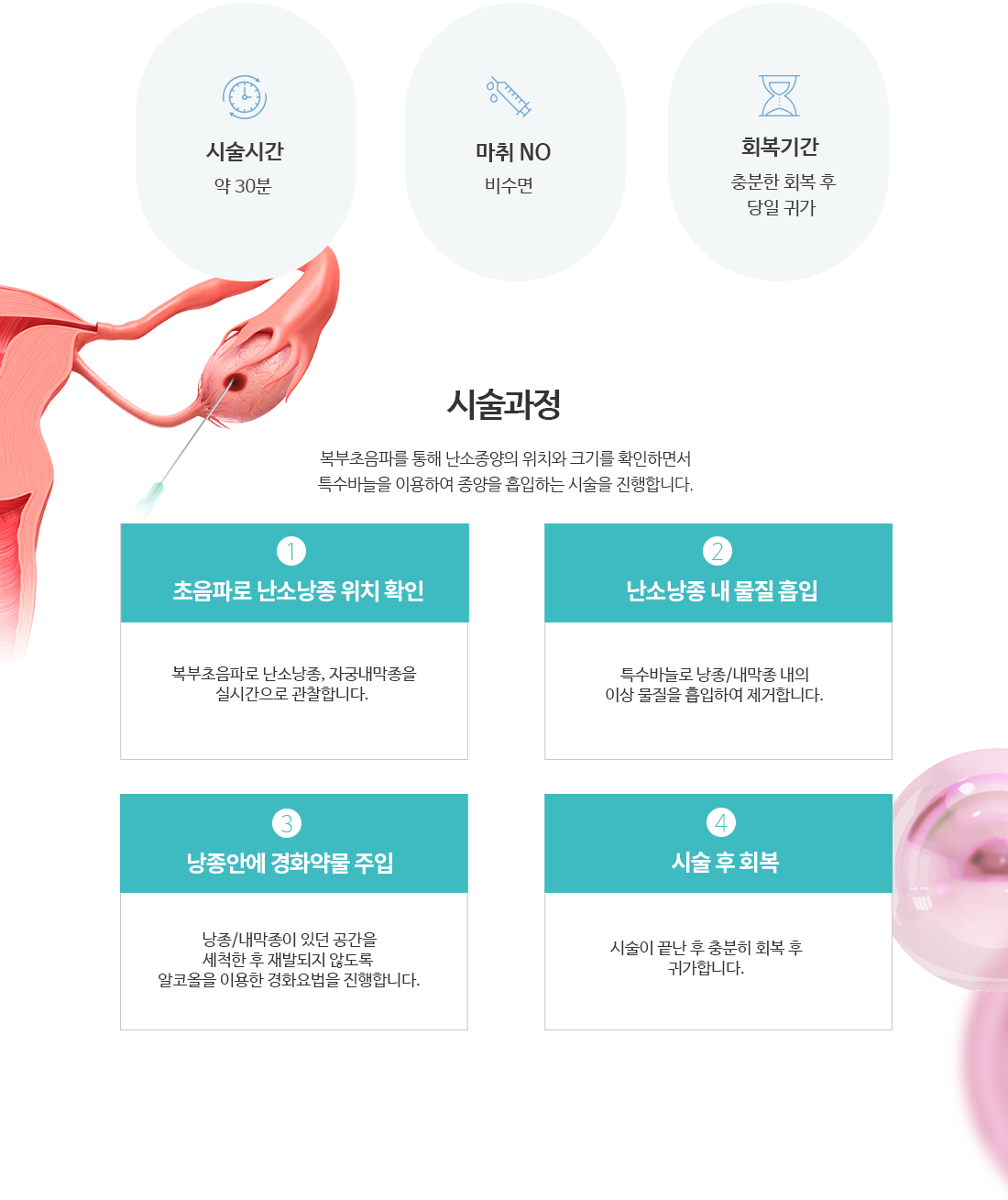 난소낭종경화술 과정