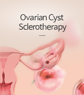 난소낭종경화술