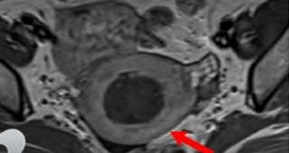 단발성 자궁선근증  80%이상 치료