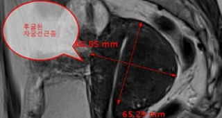 단발성 자궁선근증  80%이상 치료