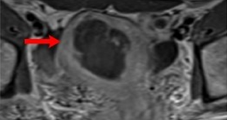 단발성 자궁선근증  90%이상 치료
