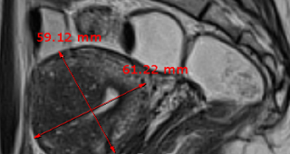 단발성 자궁선근증  90%이상 치료