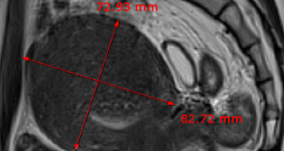 단발성 자궁선근증  90%이상 치료