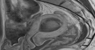 단발성 자궁근종  90%이상 치료