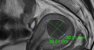 단발성 자궁근종  90%이상 치료