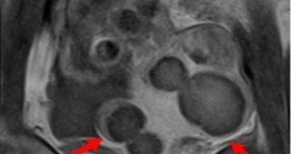 다발성 자궁근종  90%이상 치료