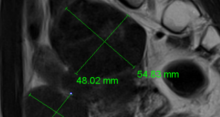 다발성 자궁근종  90%이상 치료