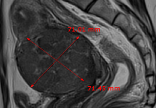 자궁근종 비수술 하이푸 치료 후 임신Case
