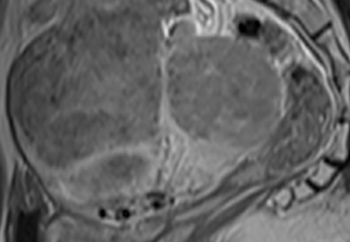 자궁근종 하이푸치료 후 임신분만사례