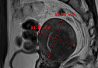자궁선근증 비수술 하이푸 치료 후 임신사례