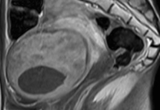 자궁근종 비수술 하이푸 치료 후 분만사례