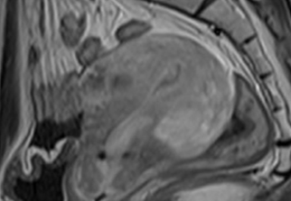 자궁근종 비수술 하이푸 치료 후 임신사례