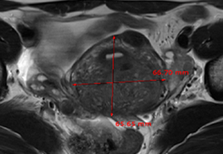 자궁선근증 하이푸시술 후 임신출산 사례
